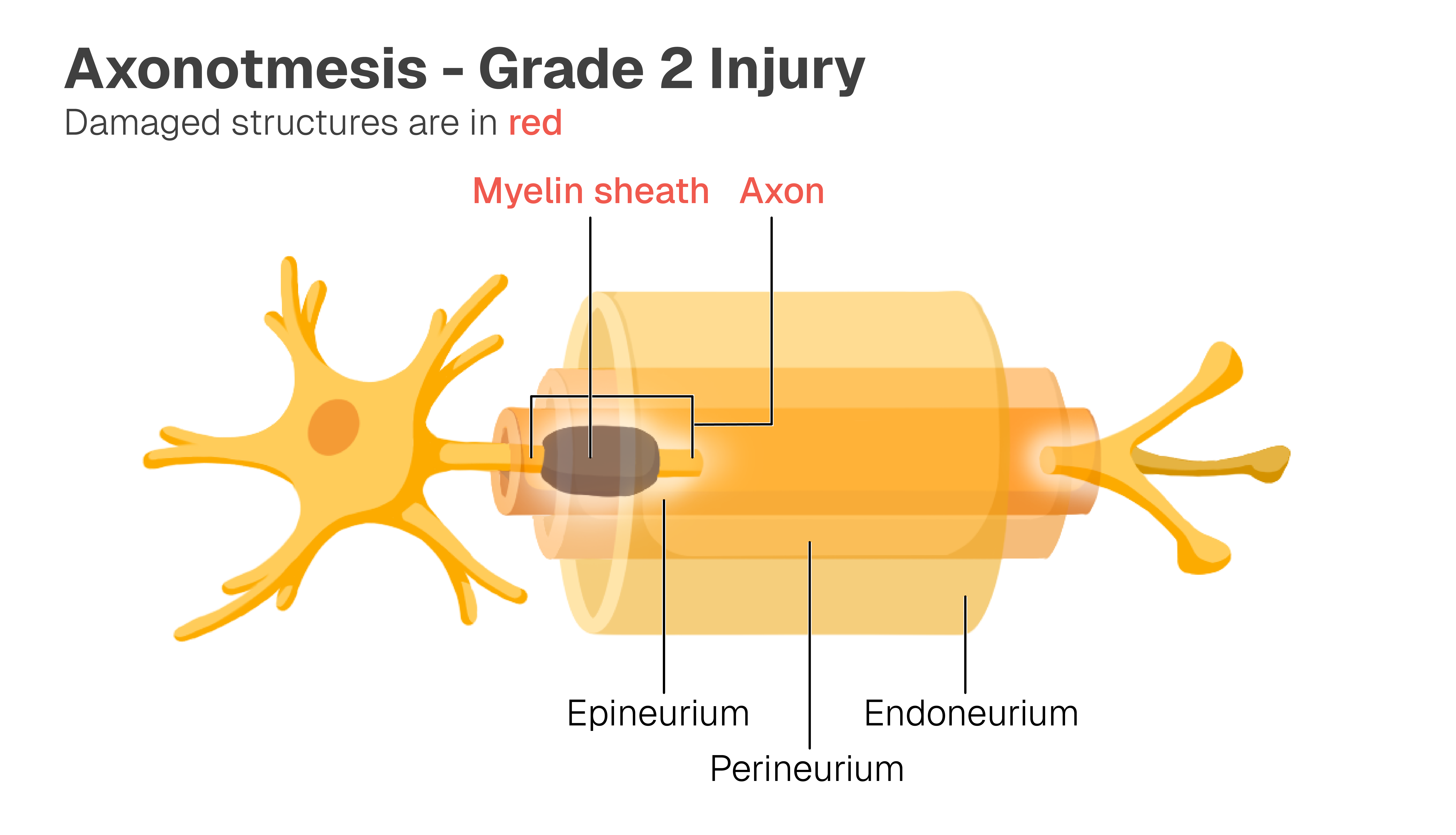 Image of normal neuron with the myelin sheath, axon, epineurium, perineurium, and endoneurium labelled. The myelin sheath, axon, and epineurium are damaged.